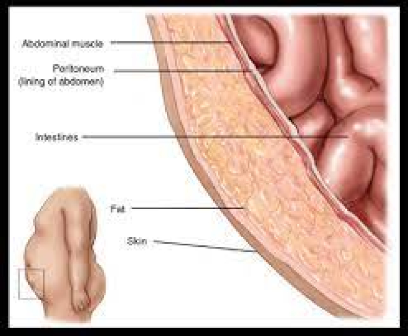 hernia-918e21f8bc2899043ff3b709e924e0471706943298.jpeg