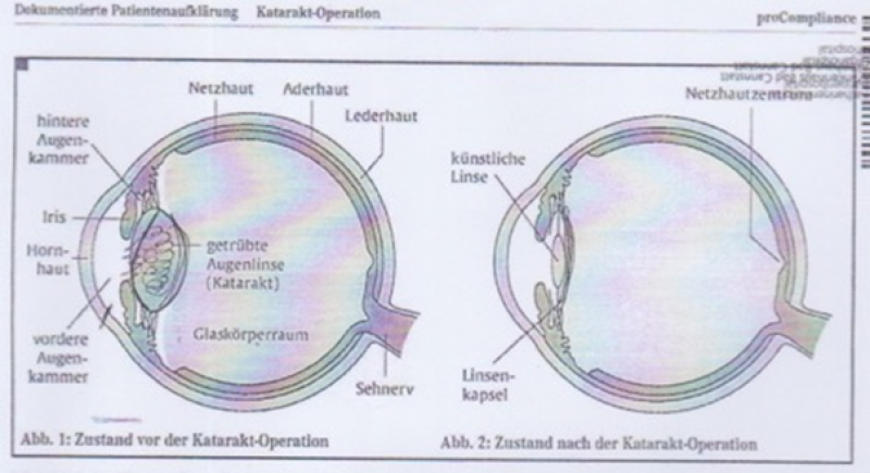 an-eye-before-and-after-cataract-operation-11633da0c77d09df755abf6dc171063c1699977082.png
