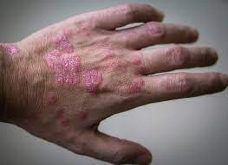 psoriasis-da0b68fa6e9691095b2851a9191f82c71704160713.jpeg