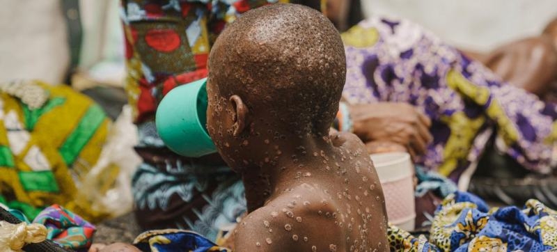 a-child-suffering-from-mpox-at-the-mpox-isolation-unit-of-the-unicef-supported-kavumu-hospital-in-south-kivu-province-dr-congo-b54f437c48eef99cd78a9db1ff3794541725679817.jpg